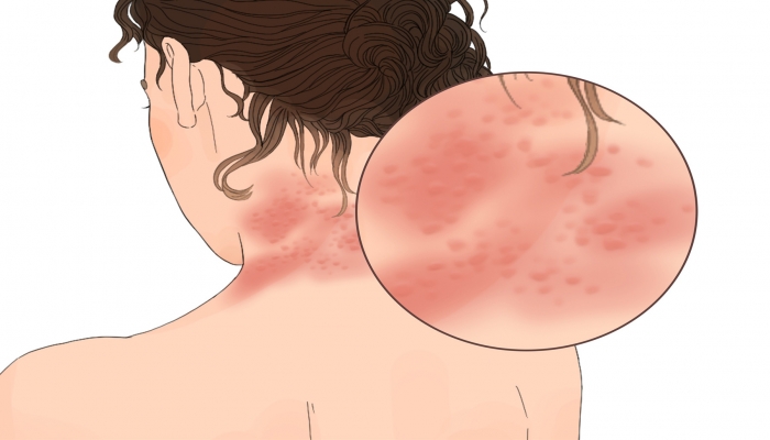 医生吃头孢遇险，“一不小心成为反面教材”